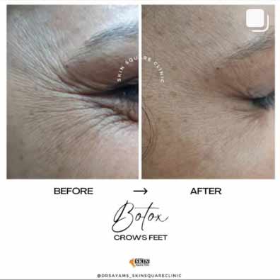 botox-crowsfeet1