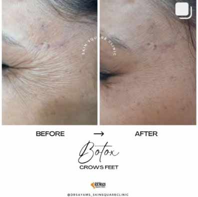 botox-crowsfeet2