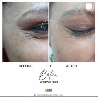 botox-crowsfeet3