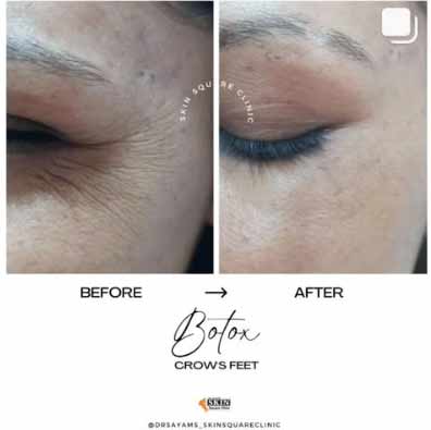botox-crowsfeet4