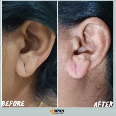 ear-lobe-repair1