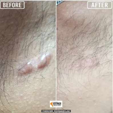 keloid-transformation1