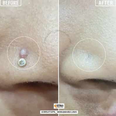 keloid-transformation11