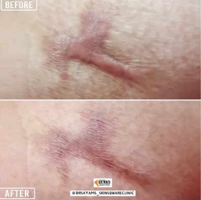 keloid-transformation12