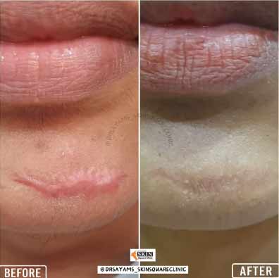 keloid-transformation13