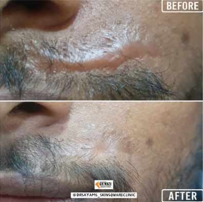 keloid-transformation14