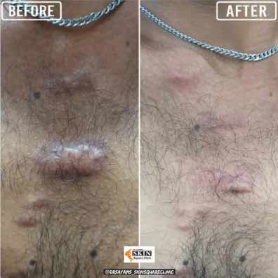 keloid-transformation2