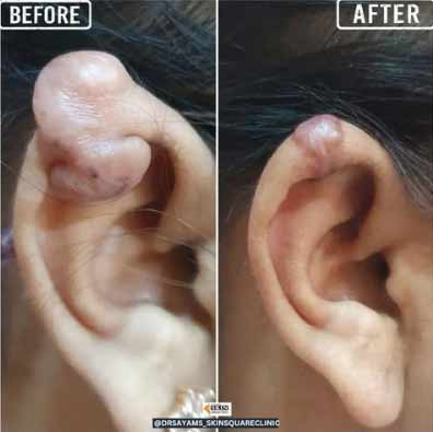 keloid-transformation4