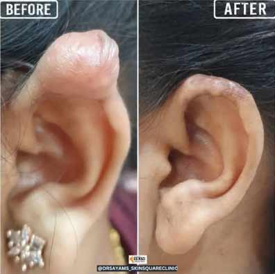 keloid-transformation5