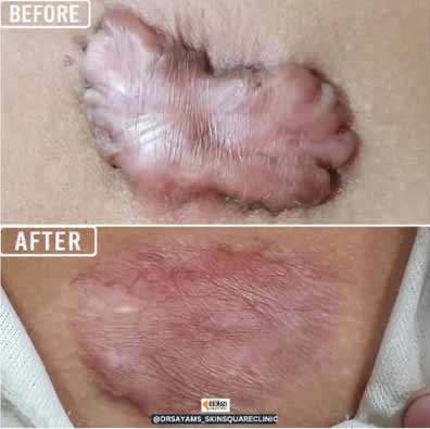 keloid-transformation6