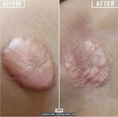 keloid-transformation7