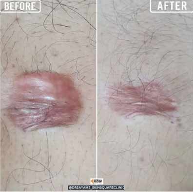 keloid-transformation8