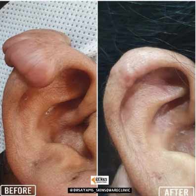 keloid-transformation9