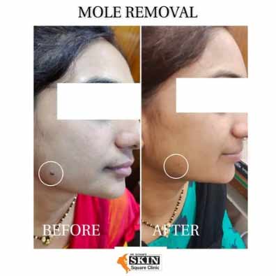 mole-removal1