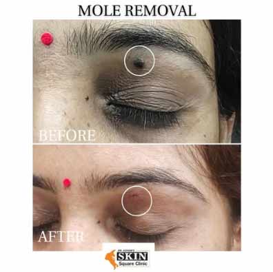 mole-removal2