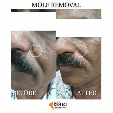 mole-removal3