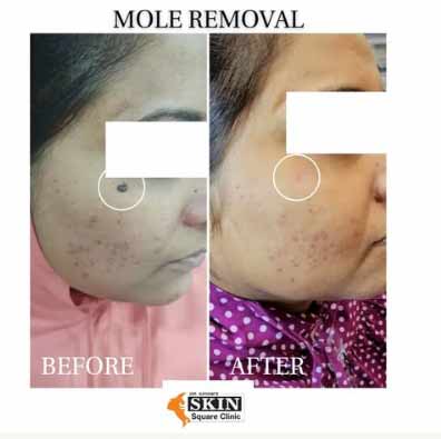 mole-removal4