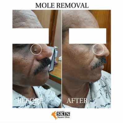 mole-removal5