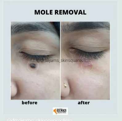 mole-removal6